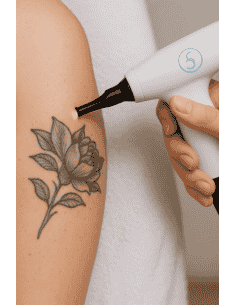 Servicio de Eliminación de Tatuaje 3x3 cm – Estudio The White Dog